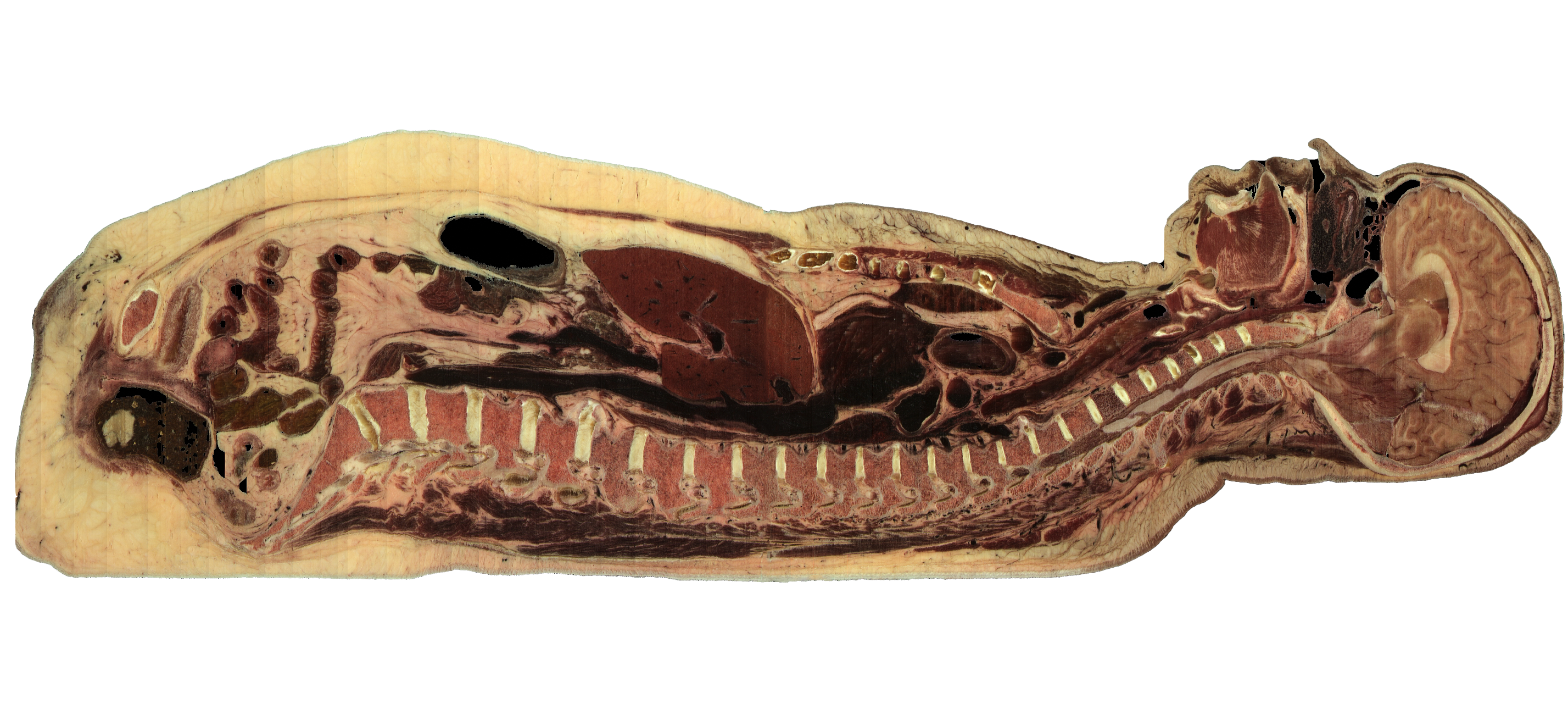 female cadaver saggital cut Cadaviz